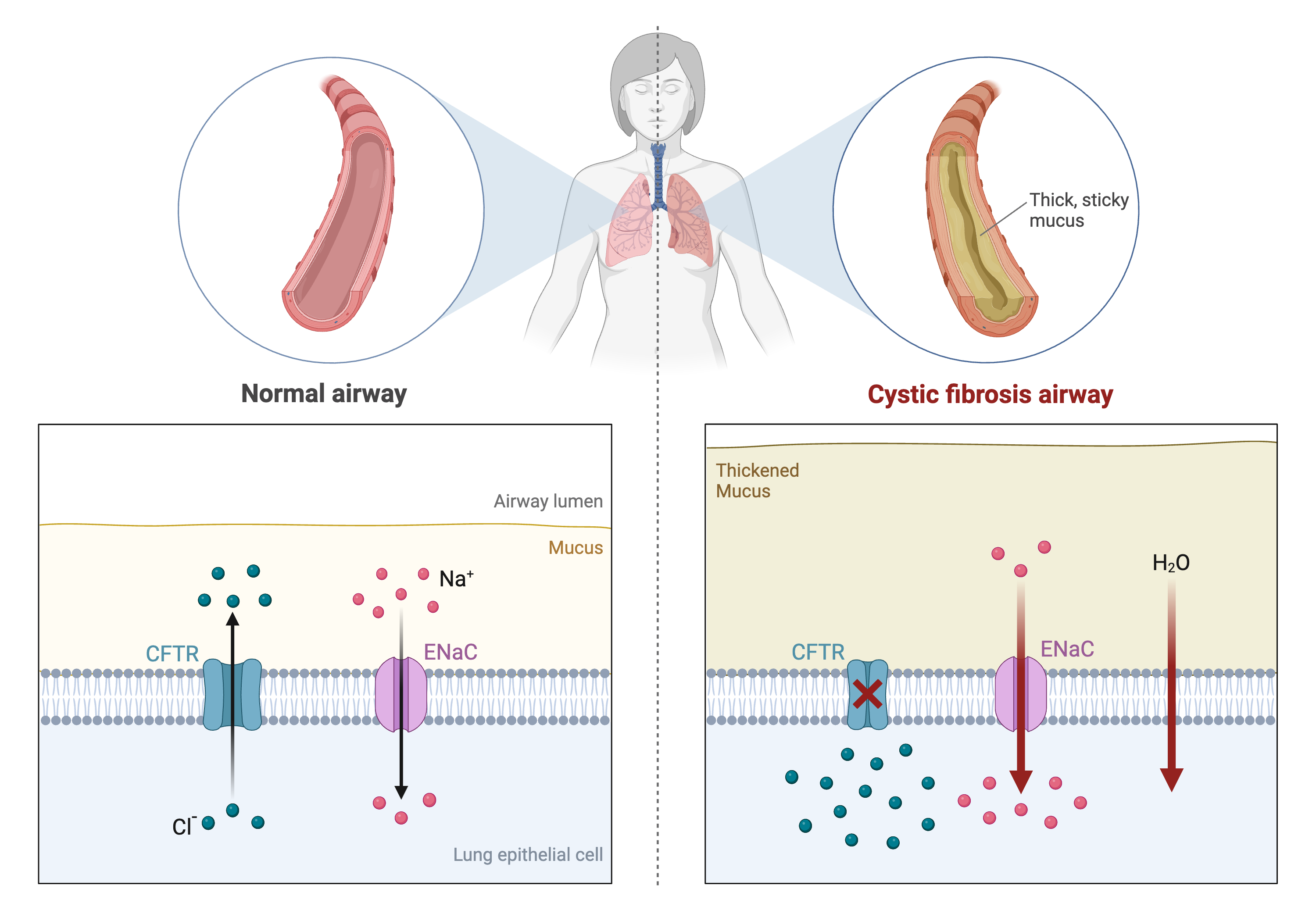 Cystic fibrosis is caused by a mutation in the CFTR gene that prevents passage of chloride ions from the airway lumen of the lungs. This results in a loss of water from the airway lumens and a thick sticky mucus in the airway.